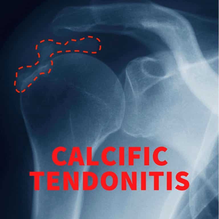 Calcific Tendonitis Causes Symptoms Treatment