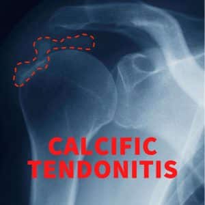 Calcific Tendonitis