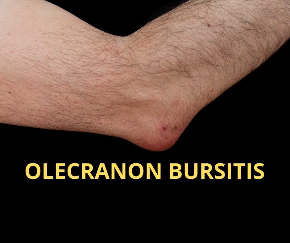 Olecranon Bursitis Elbow Bursitis | Images and Photos finder
