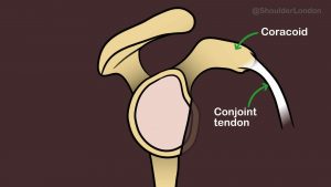 Anterior shoulder dislocation surgery for bone loss