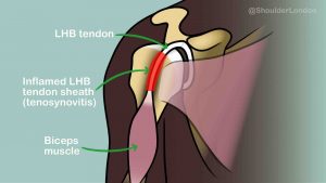 Long Head of Biceps Tendon Problems include LHB Tenosynovitis