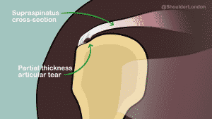 Articular sided partial thickness tear
