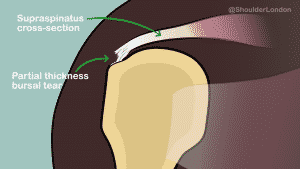 Bursal sided partial thickness tear