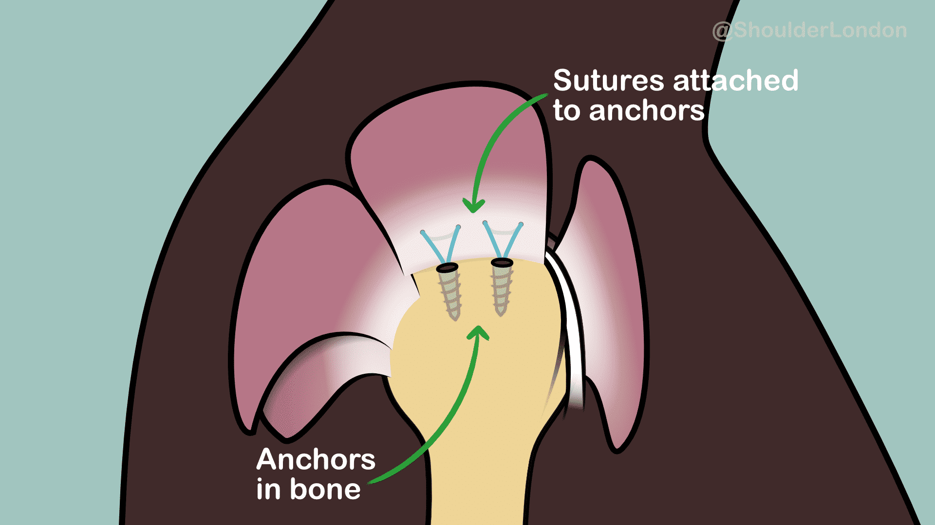 Rotator cuff tear - Specialist surgical treatment with key hole