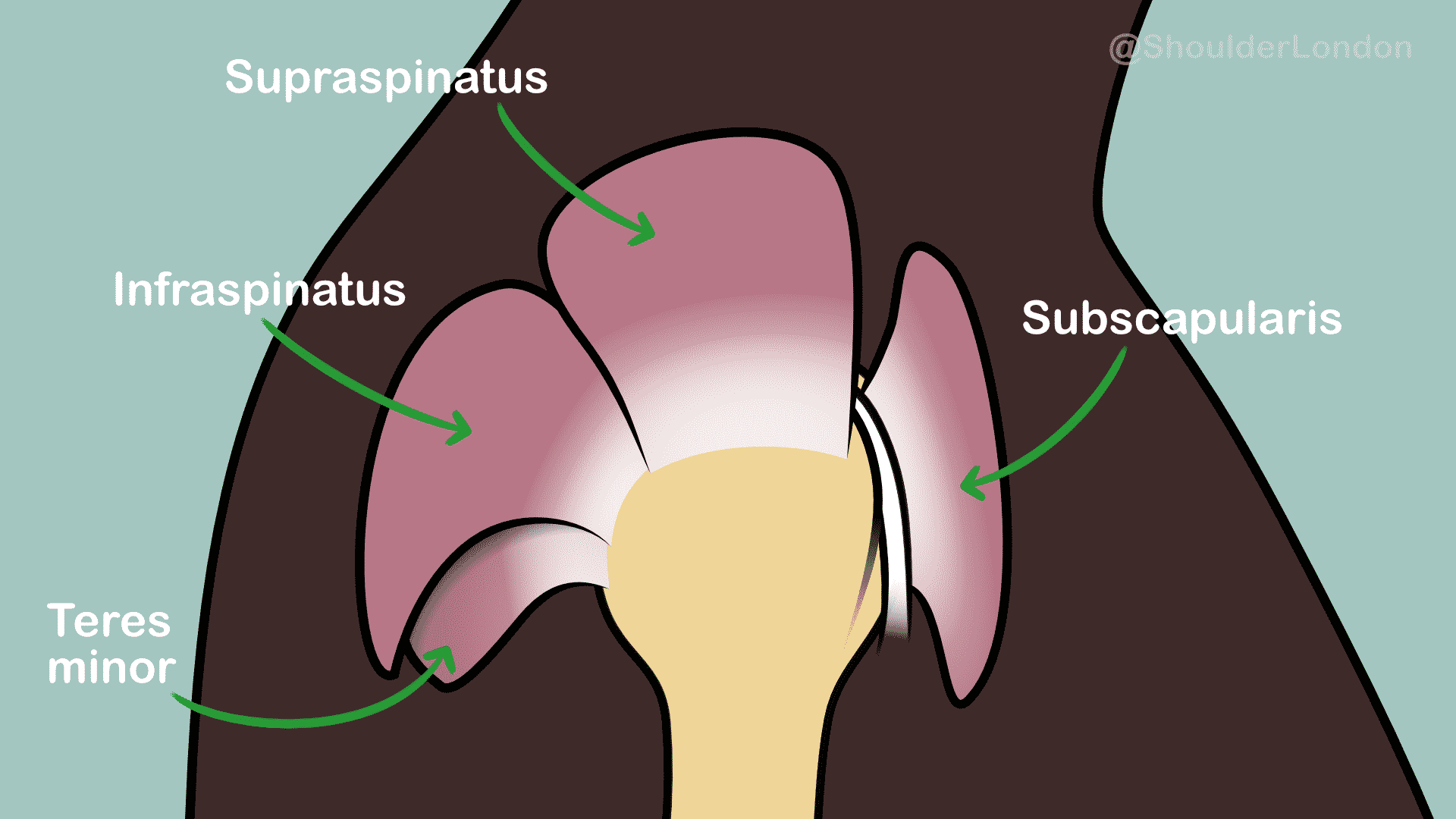 supraspinatus muscle tear