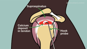 Arthroscopic excision of calcific tendonitis