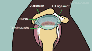 rotator cuff tendinopathy